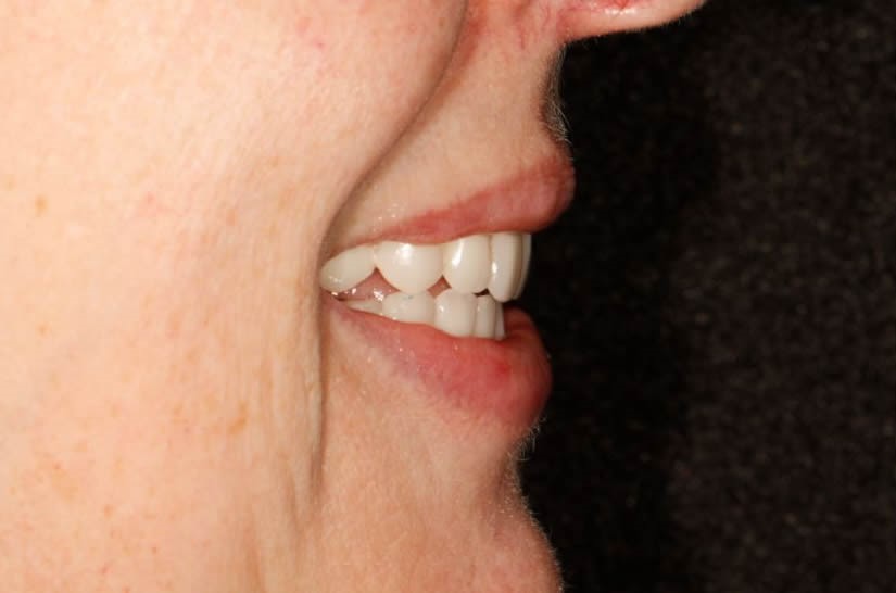Lesley Same Day Implants After